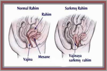 rahim sarkması tedavisi