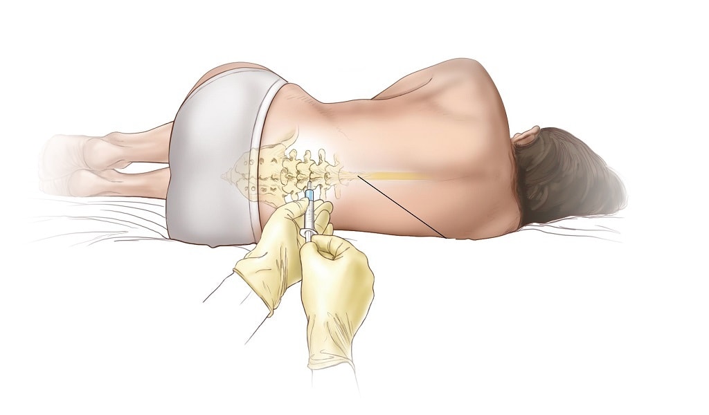 spinal anestezi