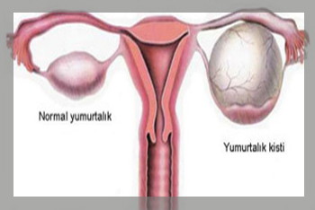 yumurtalık kistleri