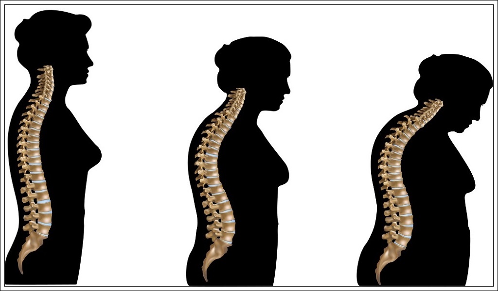 Osteoporoz önlenebilirmi